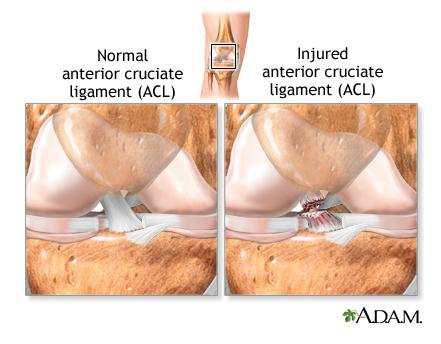 Anterior Cruciate Pic