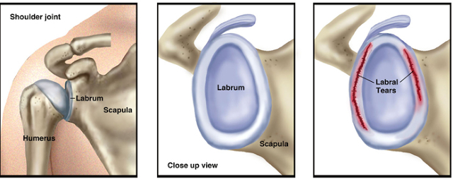 Labrum Pic