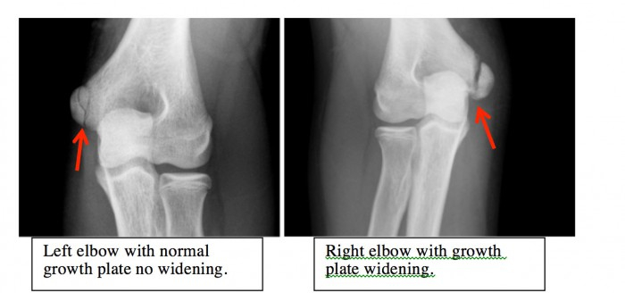 X ray Pic 2